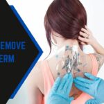How To Remove Saniderm