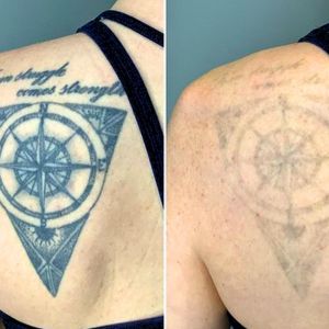 faded tattoo removal